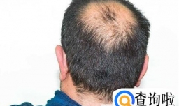 熬夜真的会秃头吗