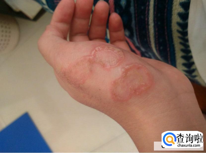 猫毛过敏有哪些症状