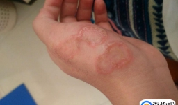 猫毛过敏有哪些症状