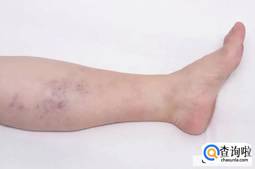 静脉曲张是日常哪些习惯造成的