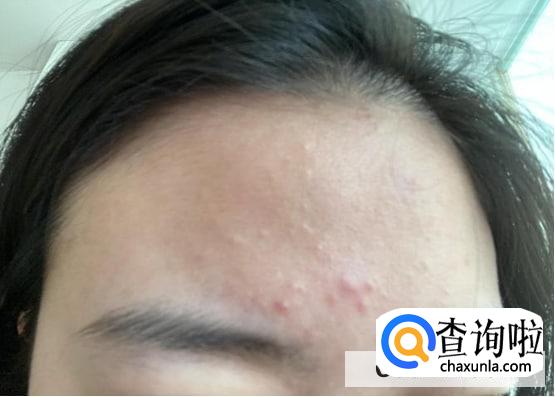 为什么吃辣的长痘