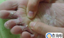 脚趾间溃烂的原因和解决的办法