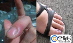 指甲盖与肉分离怎么办分享二十八种指甲断病