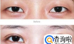 肿眼泡割双眼皮图片