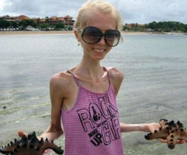 世界上最瘦的人