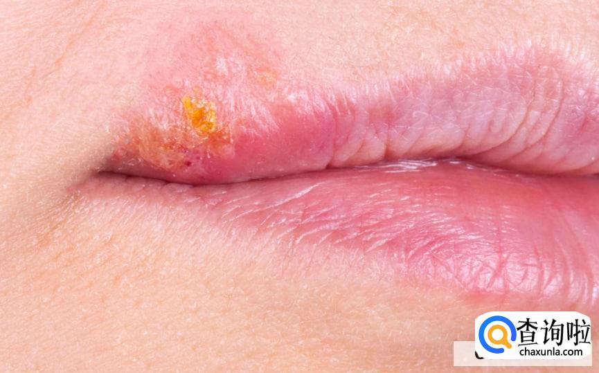 嘴上疱疹有脓能挤么