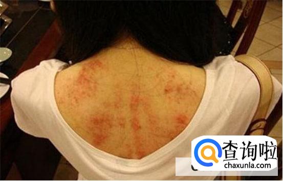 刮痧时的注意要点
