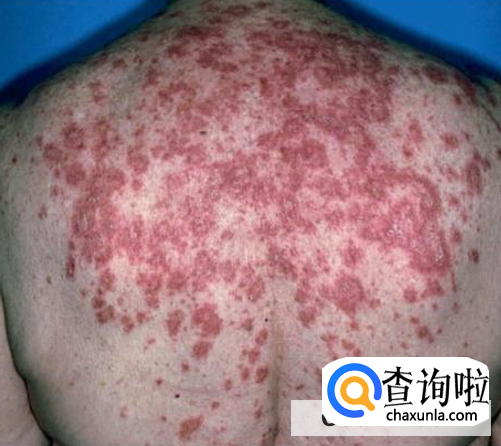 红斑狼疮的原因是什么