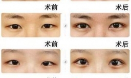 埋线双眼皮手术过程是怎样的？