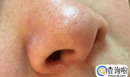 你对黑头有多少的了解呢？