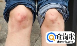 类风湿能治愈吗