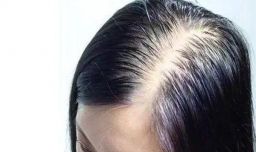 脱发多少根才是算正常的