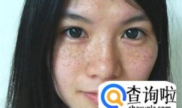 激光祛斑掉痂后红印能去掉吗