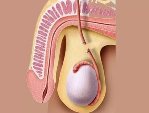 避孕方法有哪些