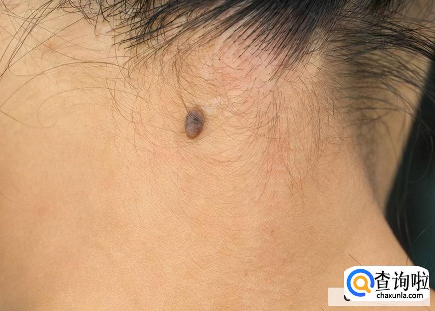 痦子有必要去掉吗