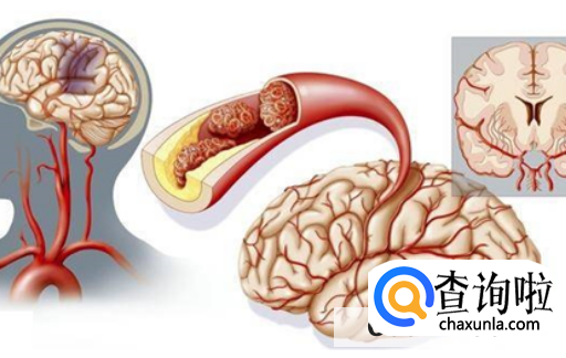 脑梗塞有哪些前兆