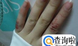 如何选购冻疮膏，冻疮膏挑选哪个牌子好技巧