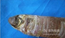 破伤风是什么意思