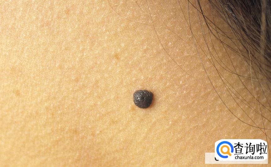 痦子有必要去掉吗