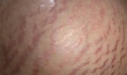 妊娠纹刚长是白色的吗