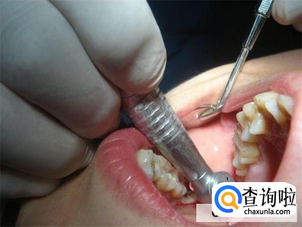 拨牙后几天恢复正常