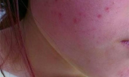 用面膜后脸上过敏了怎么办