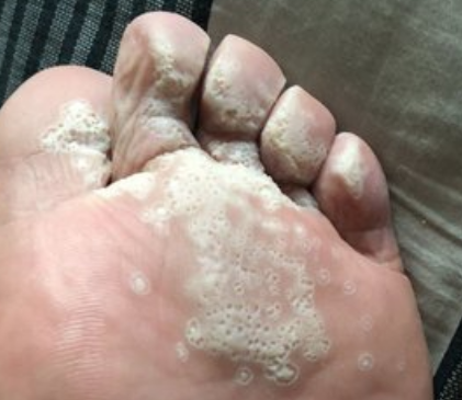 真菌感染怎么办