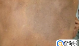 皮肤发黑呈皮革样是什么病