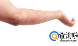 皮肤过敏症状有哪些