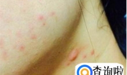 下脸颊脖子交界处长痘痘是什么原因？