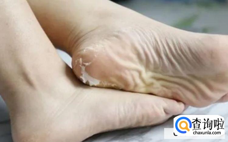 脚膜的正确用法