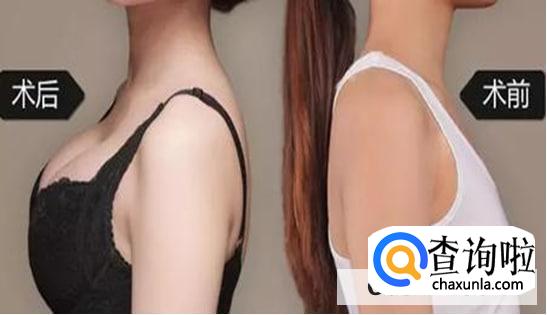 假体隆胸效果好吗