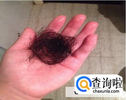 生孩子之后头发掉得很严重应该怎么办