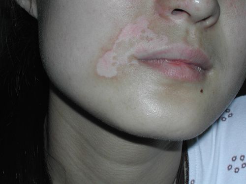 脸上长白斑是缺什么维生素