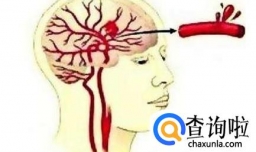 脑溢血患者发病后为什么会昏迷？多久能够苏醒