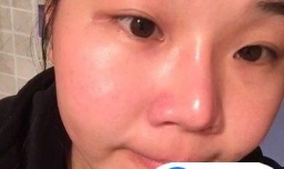 爆晒过后需要如何护肤呢