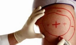 抽脂技术成熟吗？