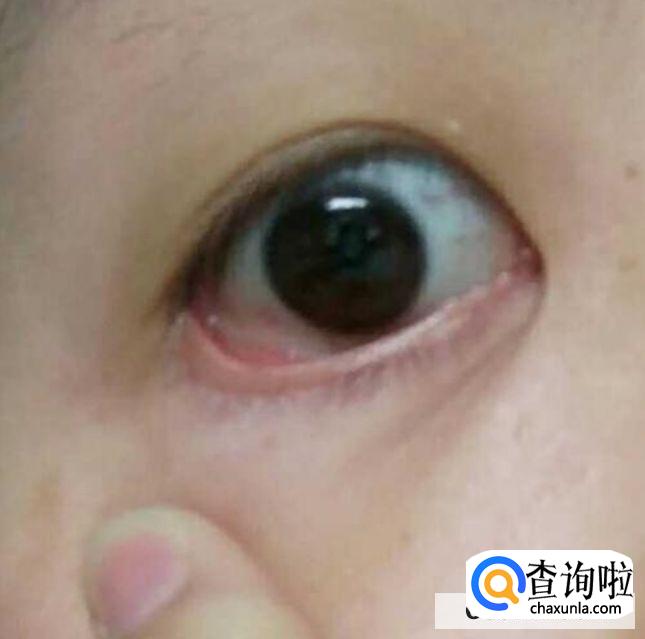 长期戴美瞳有哪些危害