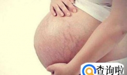 怀孕了，肚子上长妊娠纹怎么办？