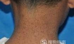 什么是色性干皮症？色性干皮症怎么治疗？